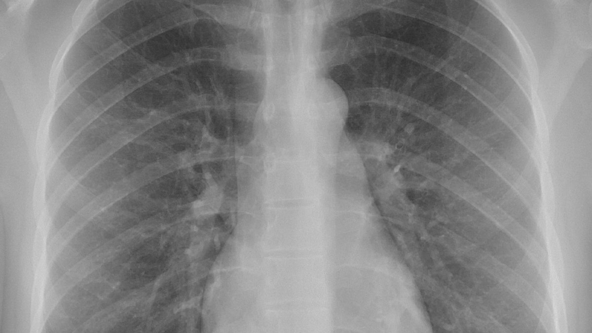 Chest X-Ray embedded in blockchain transaction